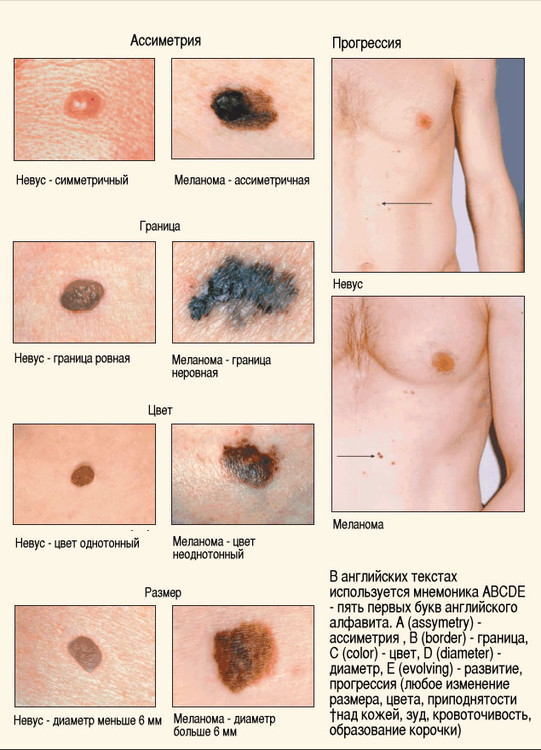 melanoma_3.thumb.jpg.0f57872863a66a33c5f62f5387a627b8.jpg